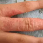 контактная аллергия на пальцах рук